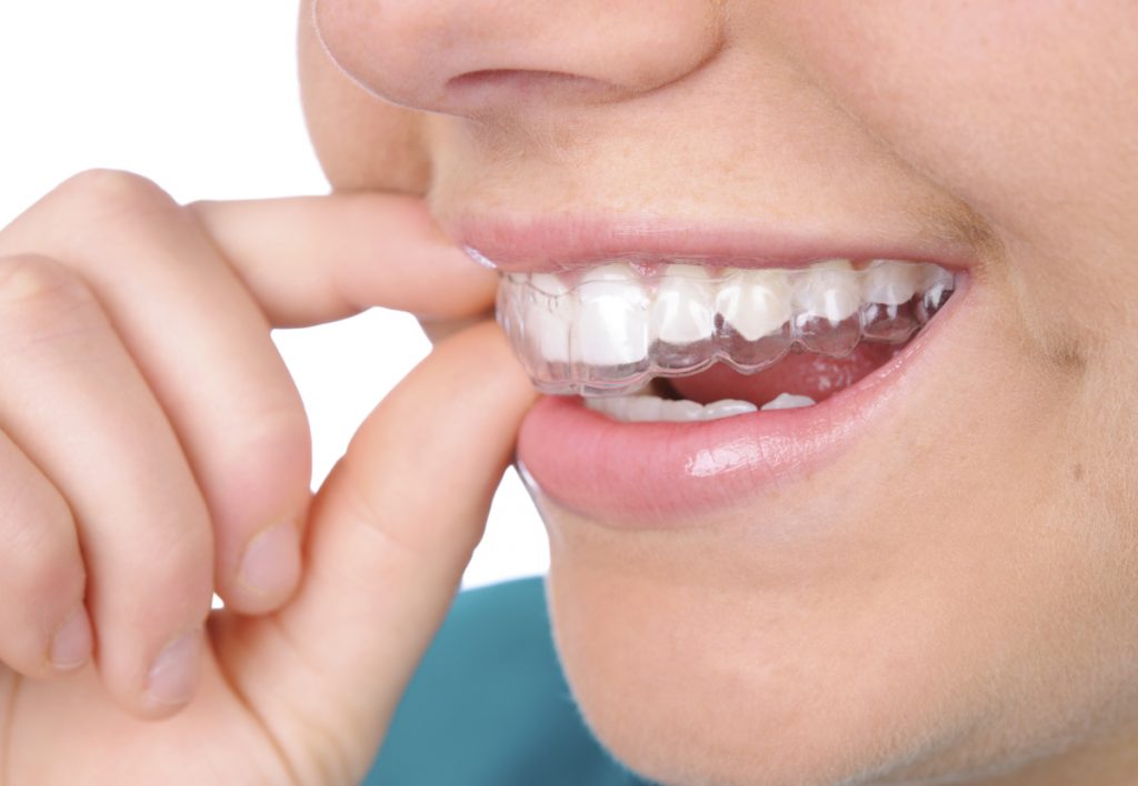 Are Dental Braces Really Beneficial For Me? Dental Braces
